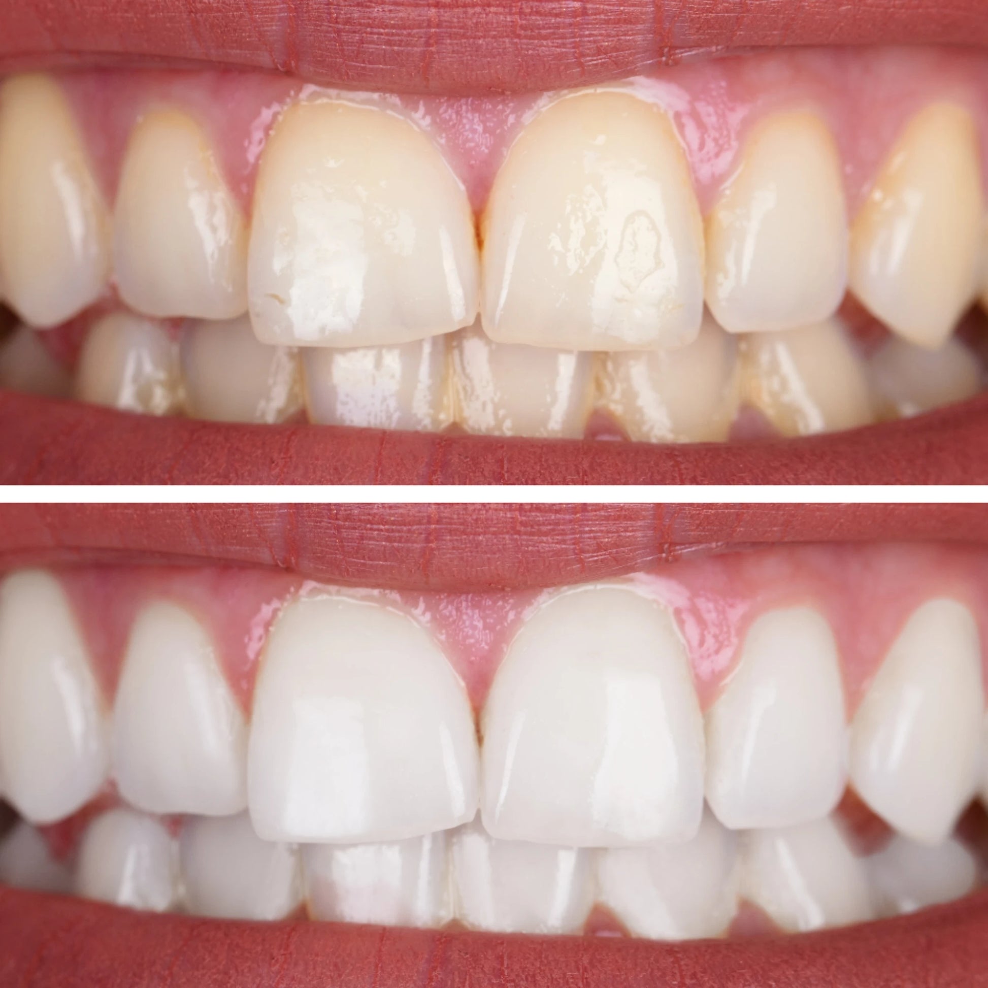 Dental hygiene kit showing before and after teeth cleaning results