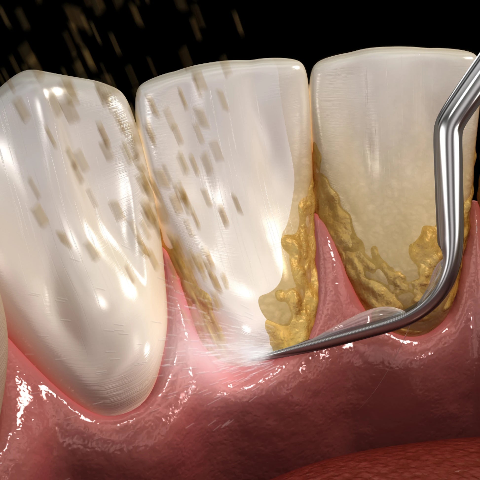 Close-up of dental work with a tool inside a tooth