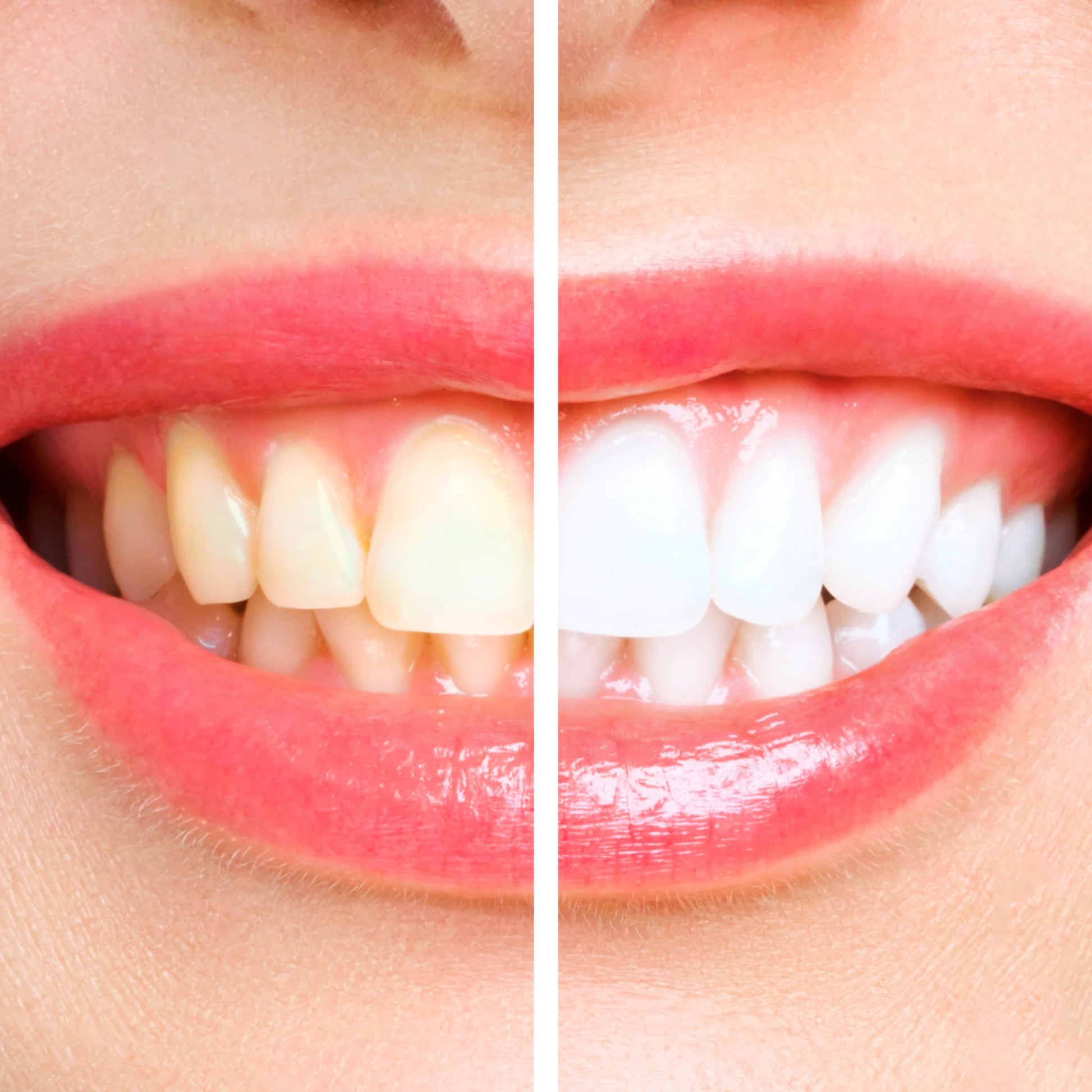 Before and after comparison of teeth whitening on a person's mouth.