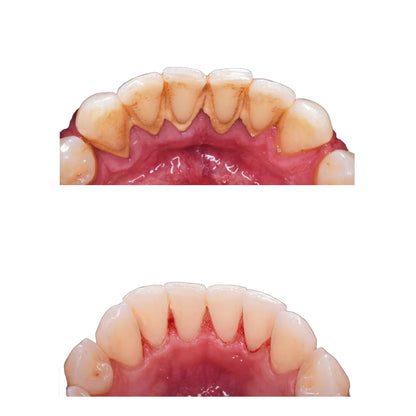 Stainless steel dental scaler removing plaque from teeth