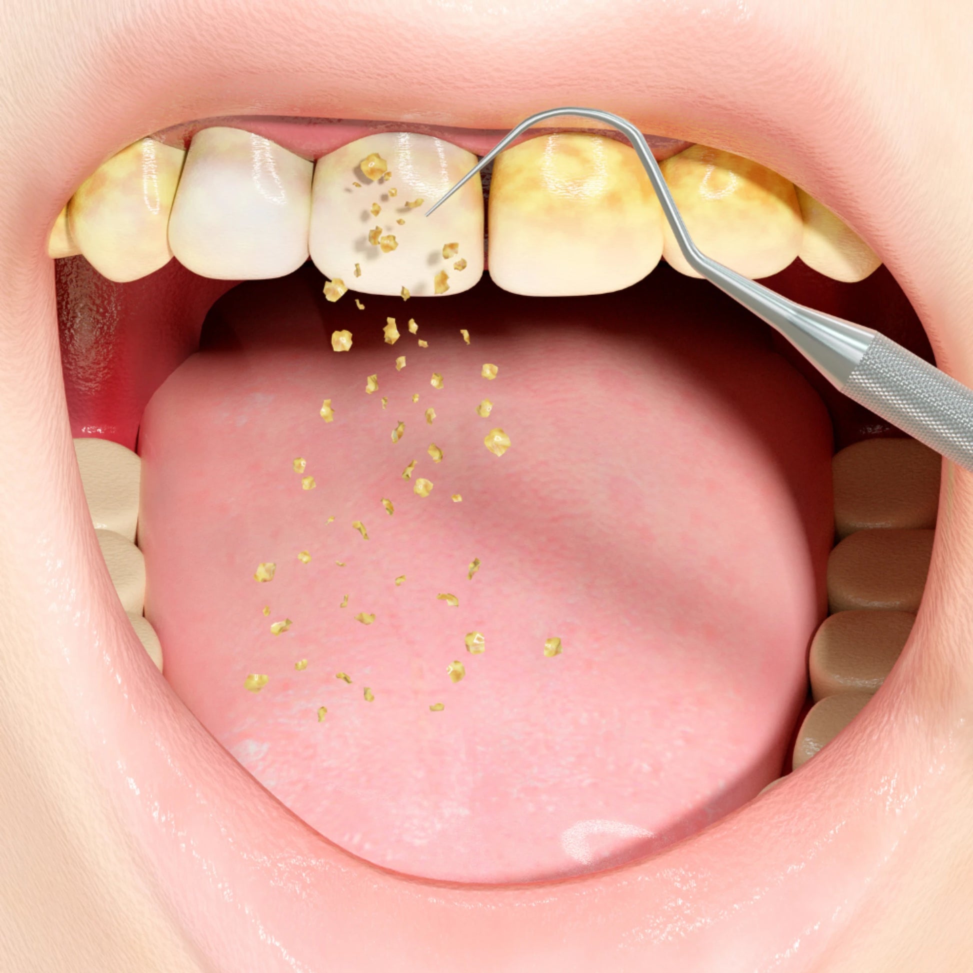 Close-up of a mouth with dental tool removing plaque, showing food particles.