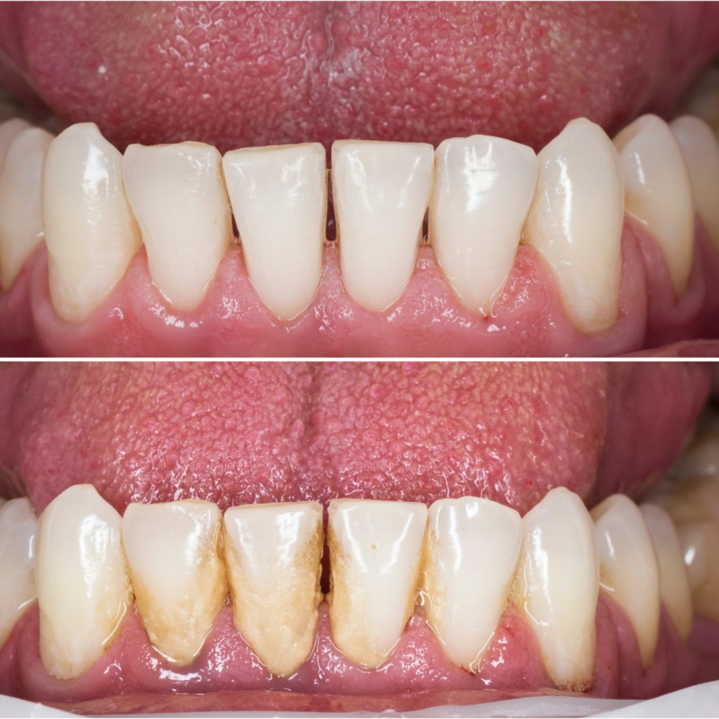 Teeth cleaning scaler tool close-up removing hardened tartar