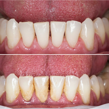 Teeth cleaning scaler tool close-up removing hardened tartar